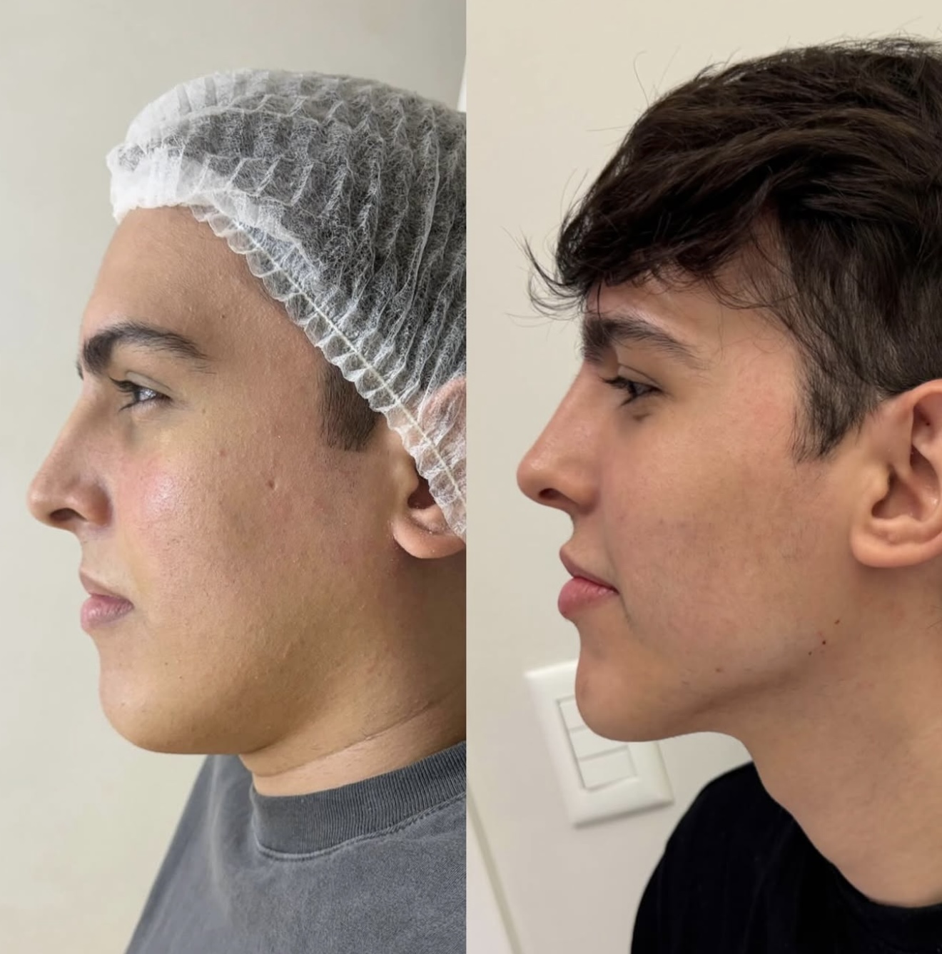 Comparativo de perfil facial antes e depois de procedimento estético