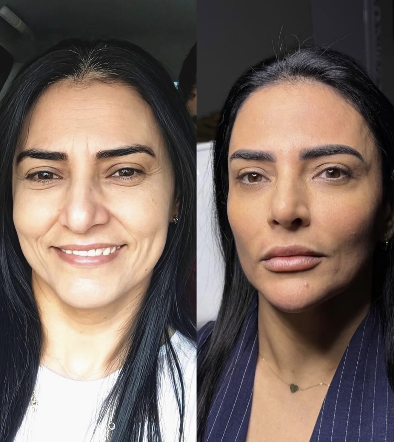 Comparativo antes e depois de procedimento estético facial